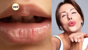 फटे होंठों से राहत पाने के घर बैठे आसान उपाय